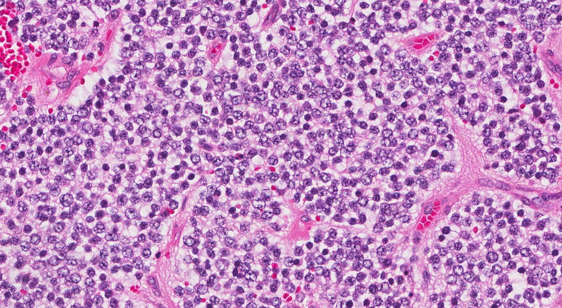Neuroblastom